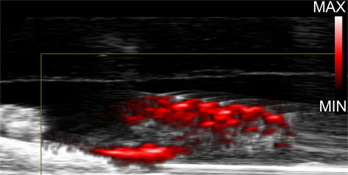 A photoacoustic medical image of infected teeth treated with gold nanoparticles