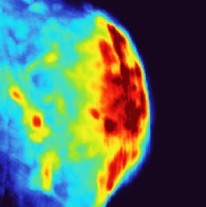 The red color on the photoacoustic image shows where the gold nanostars accumulated in a bladder tumor
