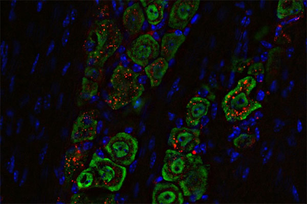 spherical nucleic acid in tumors