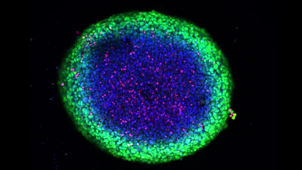 The image shows a patient-derived Glioblastoma spheroid representing an in vitro model of the tumor