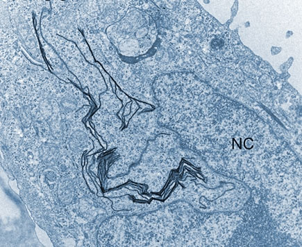 graphene oxide can be absorbed by the body's own macrophages in the lungs and crumpled up like a sheet of paper