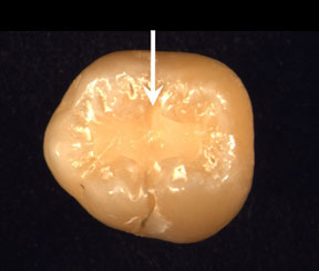 New Nanocomposites May Mean More Durable Tooth Fillings