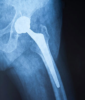 X-ray of the pelvis after a hip replacement