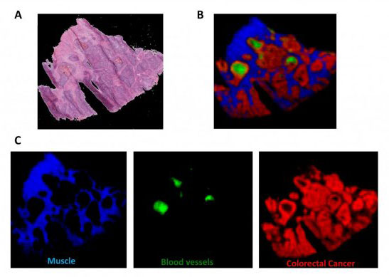 A section of bowel tissue as an optical image (A) and using mass spectrometry imaging to identify tissue types