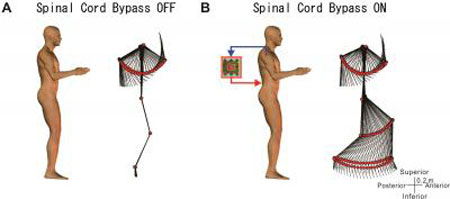 Spinal Cord Bypass