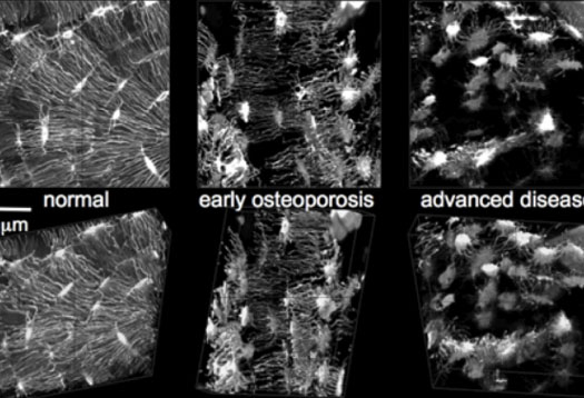 showing early and advanced osteoporosis