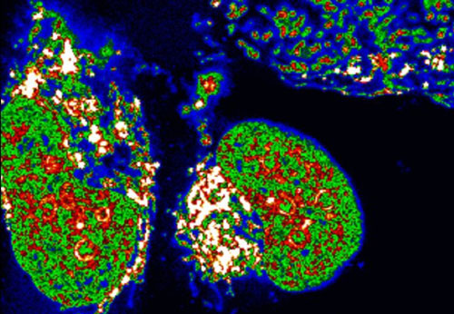 Confocal microscopy image of moleculeS inside human bone cancer cells