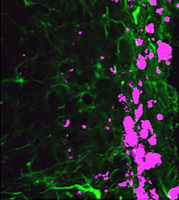 Reprogrammed stem cells (green) chase down and kill glioblastoma cells (pink)