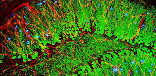 Brain showing hallmarks of Alzheimer’s disease (plaques in blue)