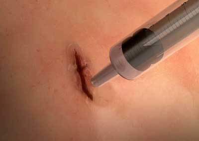 MeTro surgical glue applied to wound