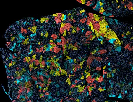 pancreatic cancer tumor