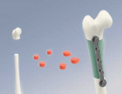 Segmental Additive Tissue Engineering (SATE)
