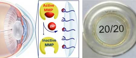 Hydrogel Contact Lens -- Corneal Melting