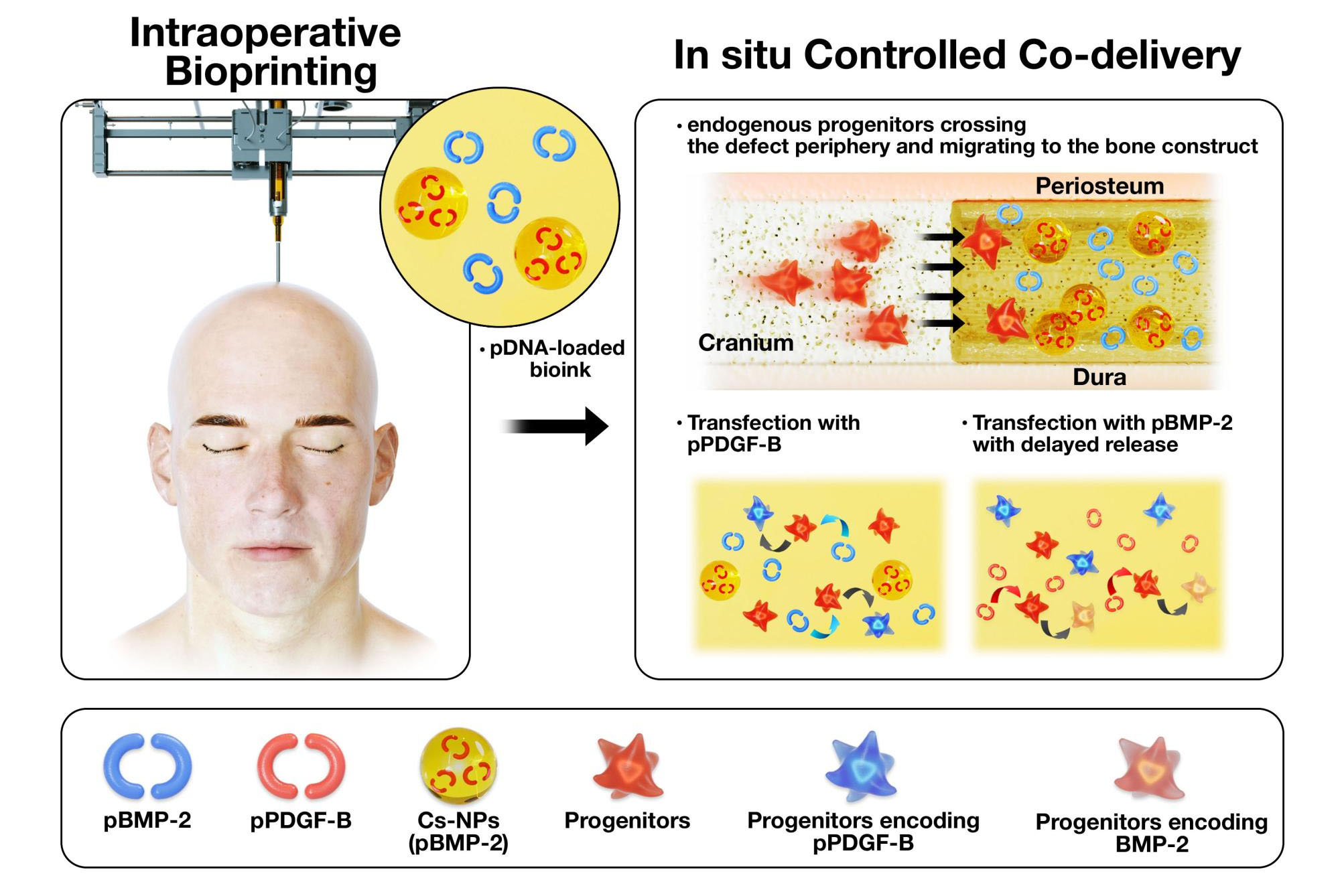 Bioprinting during surgery of bone constructs used as a controlled gene co-delivery platform for the repair of skull defects