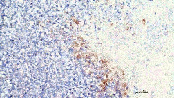 Digitally modified image of tumor cells with CRISPR/Cas9 affected cells in brown