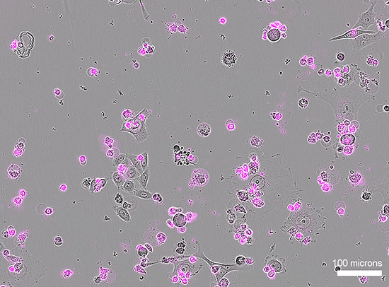 Microscope image showing human cervical cancer cells (gray) undergoing widespread cell death (magenta) after Cas12a2 treatment
