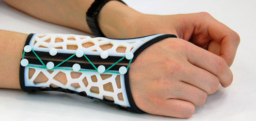 3D printed wrist splints