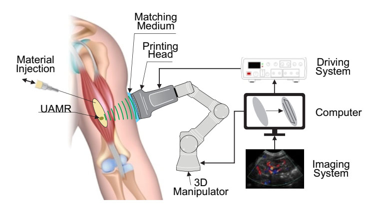 Direct sound printing technology for noninvasive inside body printing