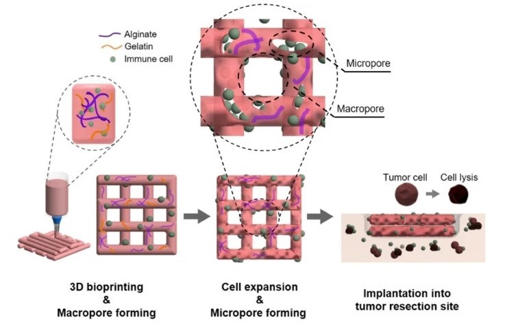 Schematic illustration of micro/macropore-forming hydrogel with NK cells fabricated by 3D bioprinting and implanted into the tumor site