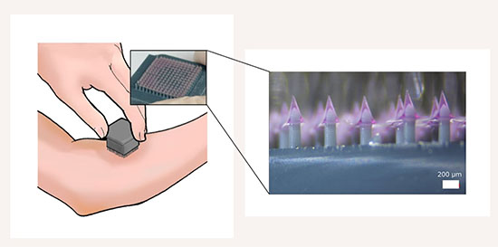 3D-printed microneedle patch