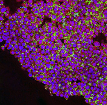 Human breast cancer cells (purple) are targeted by nanoparticles (green)