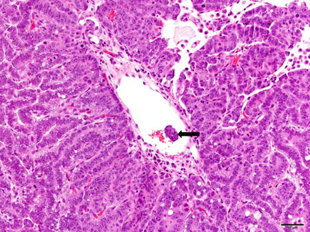 Alveolar Bronchiolar Carcinoma of the Lung with Metastases in a Blood Vessel