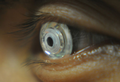 telescopic contact lens