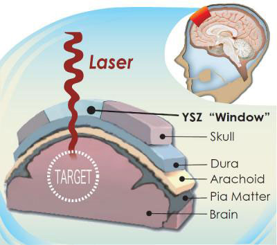illustrated cross section of the head that shows how the transparent skull implant works