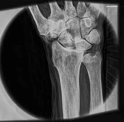 X-ray of a human wrist