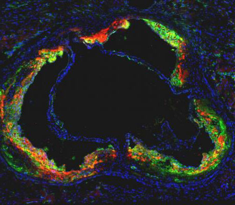 Statin Nanotherapy