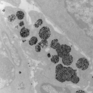 tumor cells taking up magnetic nanoparticles