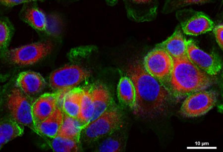 Drug delivery nanoparticles (stained red) are taken up by cancer cells