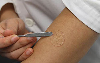 nanogel for wound treatment