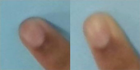 Fingertip blanching occurs when a finger presses against a hard surface