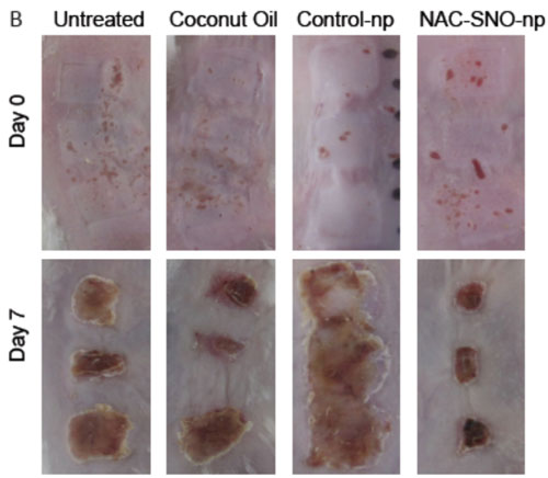 NAC-SNO nanoparticles clinically accelerate burn wound healing