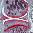 Osteoarthritis