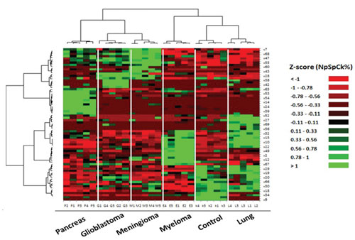 Identification and discrimination of cancers using protein corona sensor array heat maps
