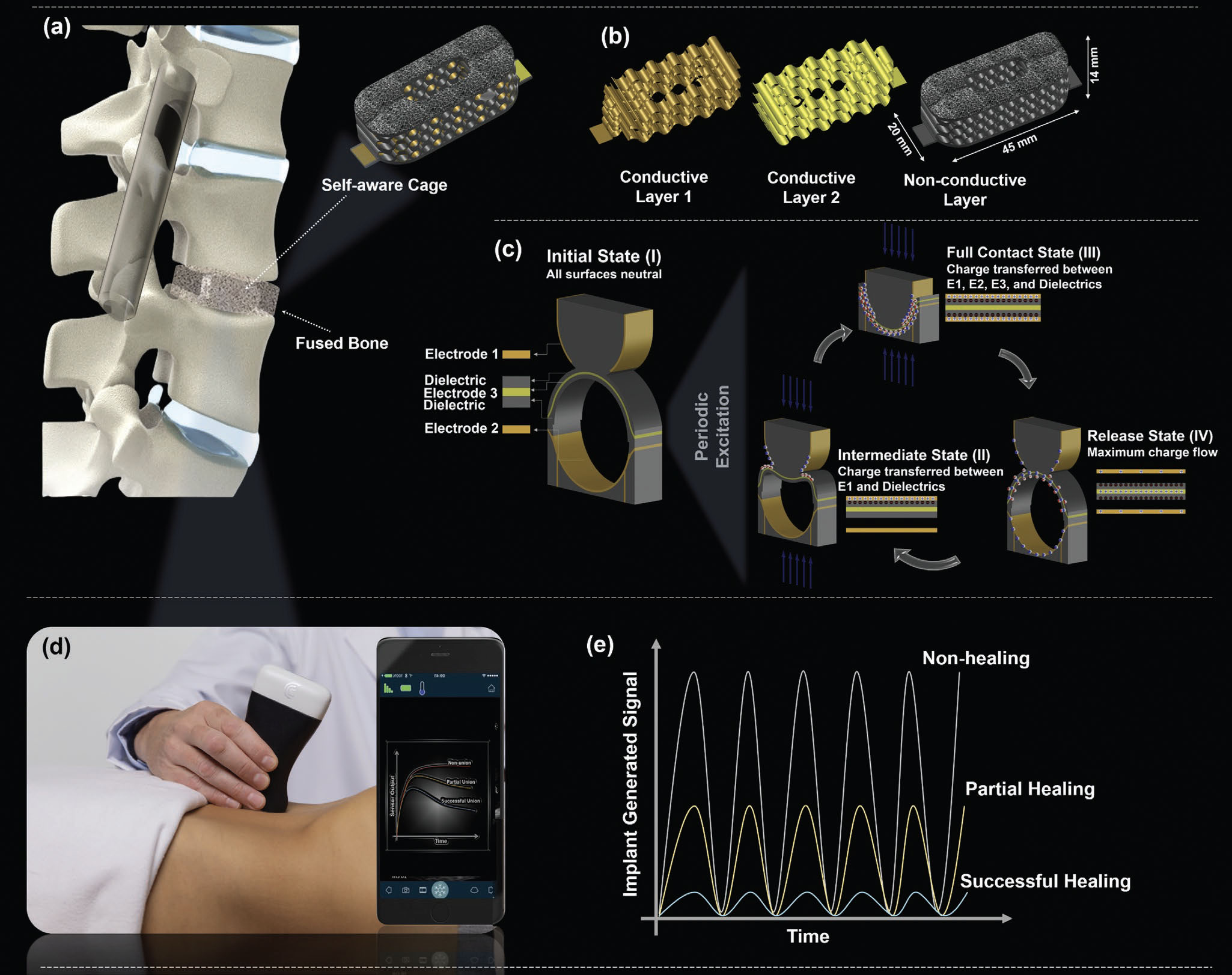self-aware metamaterial implant that can be used for reliable determination of spinal fusion development post-surgery directly at the intervertebral level