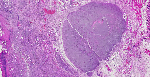 This tissue section shows how a nanosilicate-infused hydrogel implant led to new small blood vessels forming within and around the material