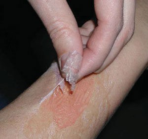 Oxygen-sensitive paint for imaging the distribution of oxygen on skin
